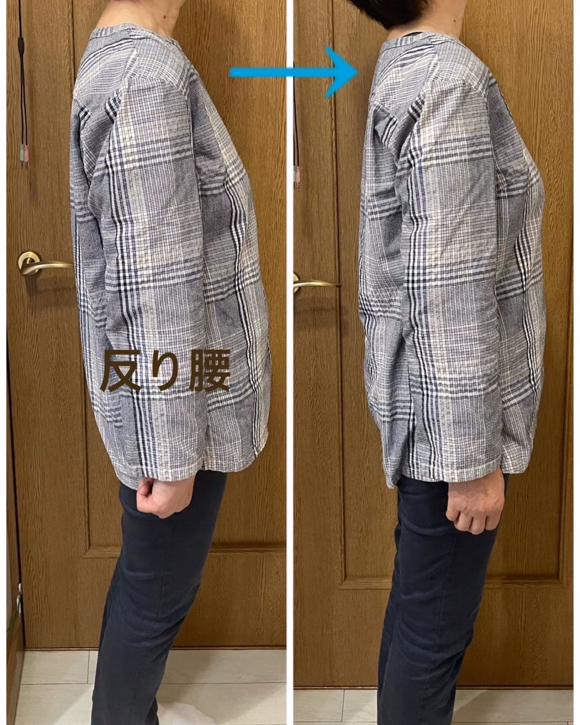 反り腰の改善 ビフォーアフター