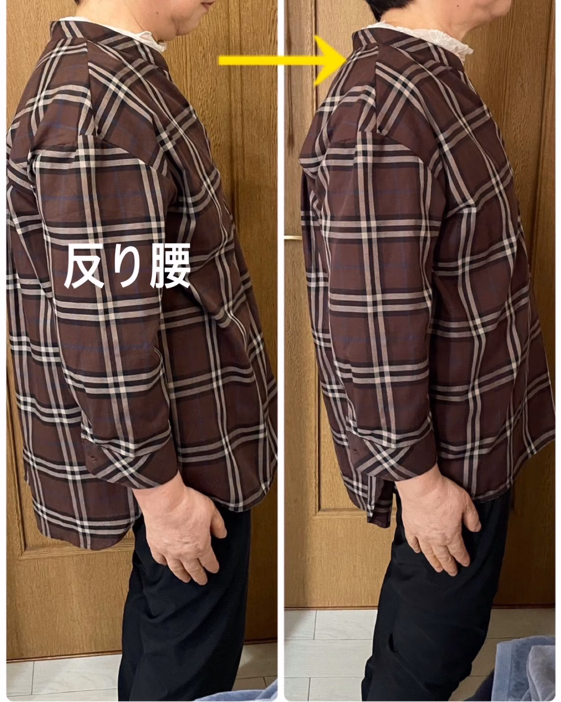 反り腰の改善 ビフォーアフター